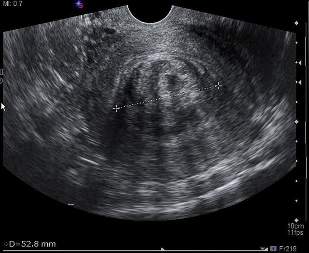 Vincentian Woman Short Nearly EC$8,000 for Life-Changing Surgery